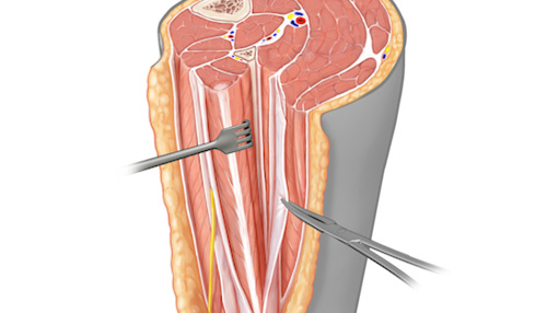 Anatomy practical: Triangular Space (Medial axillary foramen) Diagram