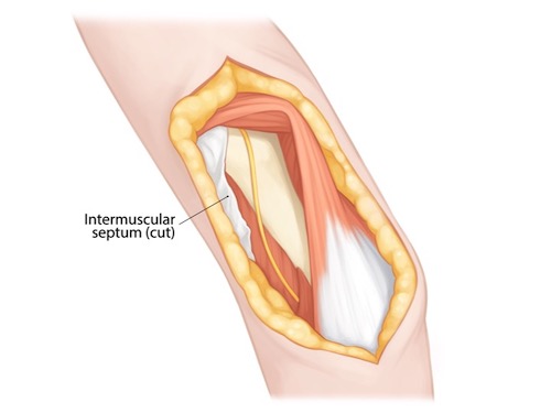 Intermuscular septum (cut)