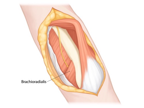 Brachioradialis