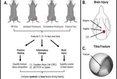 Differential fracture response to traumatic brain injury suggests dominance of neuroinflammatory response in polytrauma