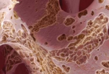 The senolytic drug fisetin attenuates bone degeneration in the Zmpste24-- progeria mouse model