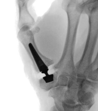 Thumb Joint Replacement