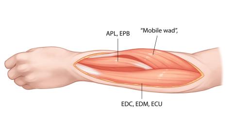 Image: Step 3 of a dorsal approach to the radius