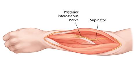 Image: Step 4 of a dorsal approach to the radius
