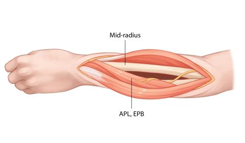 Image: Step 7 of a dorsal approach to the radius