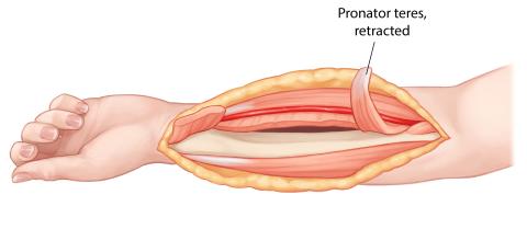 Image: Step 7 of Henry Volar Approach