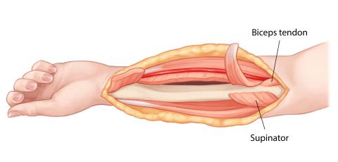image: Step 8 of Henry Volar Approach